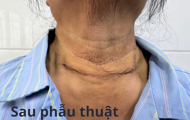 Phẫu thuật thành công bướu tuyến giáp khổng lồ thòng dưới xương đòn- Ảnh 2.