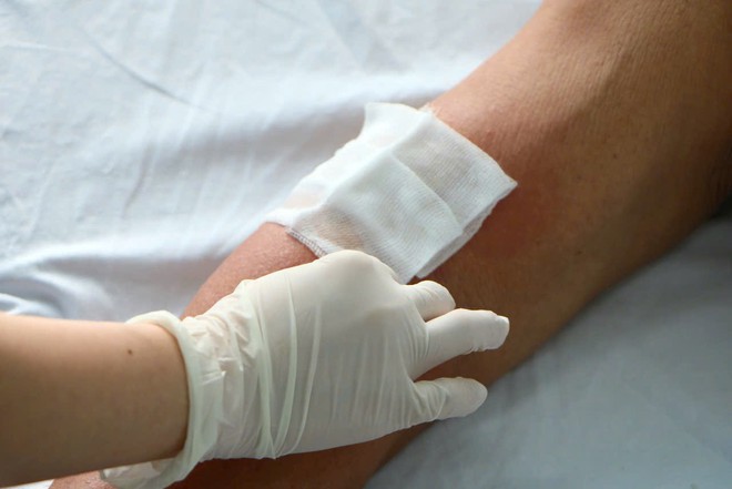 Viêm da do kiến ba khoang tăng ở Huế, cảnh báo việc tự chẩn đoán điều trị- Ảnh 5.