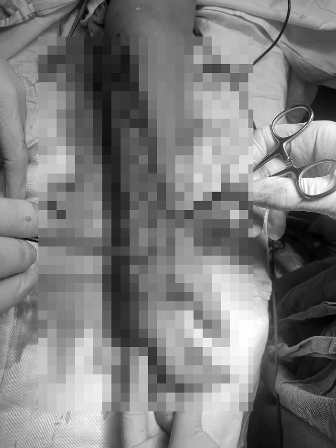 Dựng cây nêu vướng dây điện, người phụ nữ nguy cơ mất cẳng tay- Ảnh 3.