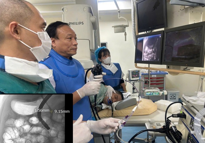 Sỏi ống mật chủ 'khủng' gây tắc mật nặng- Ảnh 3.