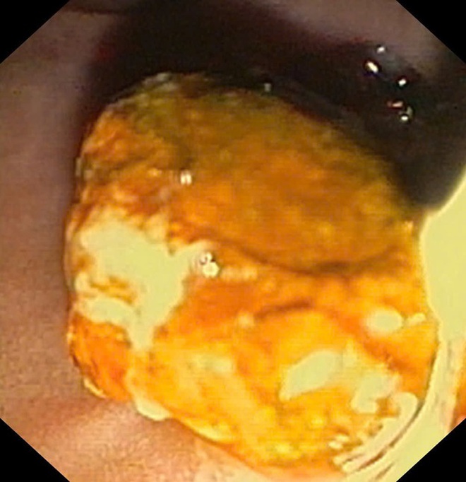 Sỏi ống mật chủ 'khủng' gây tắc mật nặng- Ảnh 4.