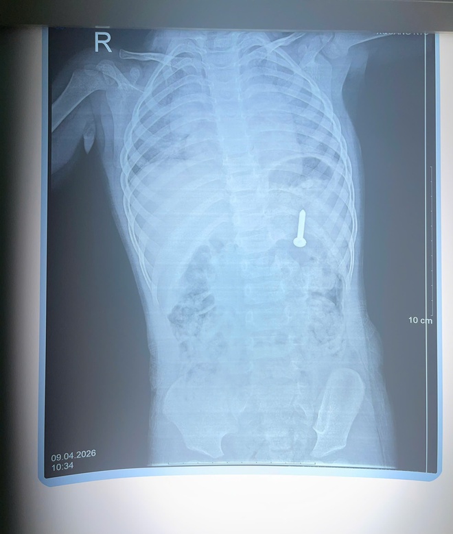 Bé 21 tháng tuổi nuốt phải đinh vít dài khoảng 2,5cm- Ảnh 1.