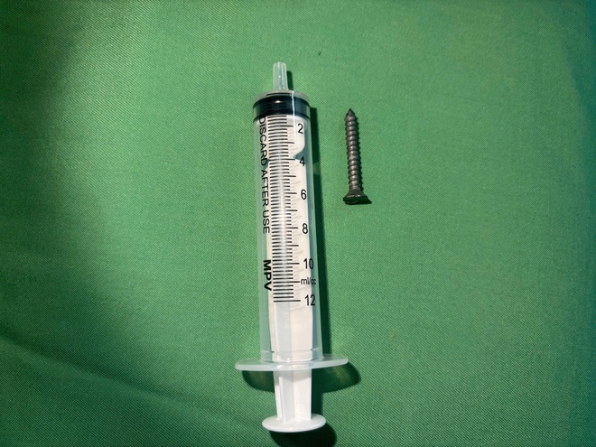 Bé 21 tháng tuổi nuốt phải đinh vít dài khoảng 2,5cm- Ảnh 2.
