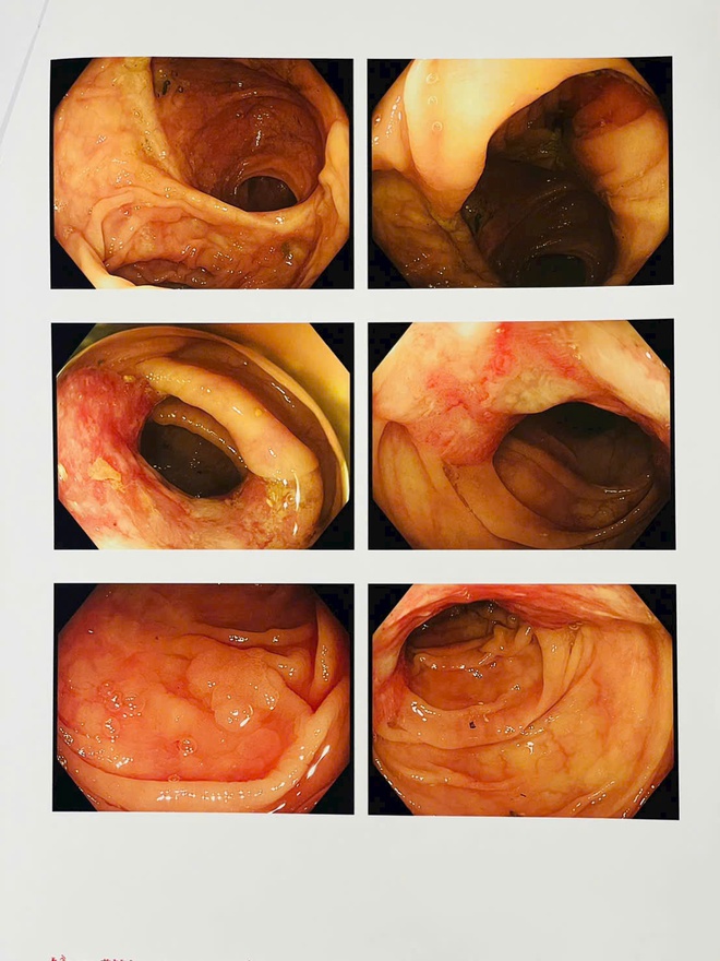 Ung thư có thể tái phát nếu chủ quan sau điều trị- Ảnh 2.