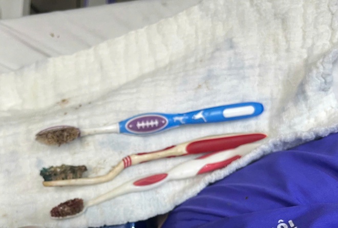 Từ ca bệnh nuốt 3 bàn chải đánh răng, cảnh báo biến chứng nguy hiểm bởi dị vật 'quá khổ'- Ảnh 2.