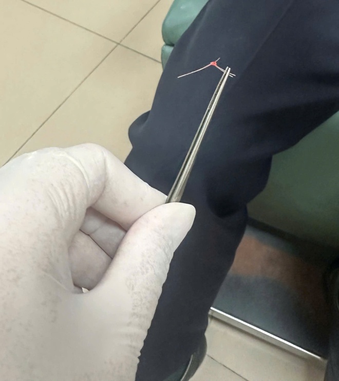Hi hữu hóc lông lợn sau khi ăn bánh mỳ pate- Ảnh 3.
