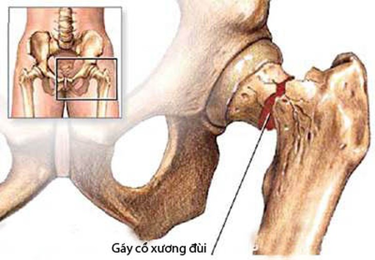 
	Cảnh giác với nguy cơ gãy xương do thuốc.