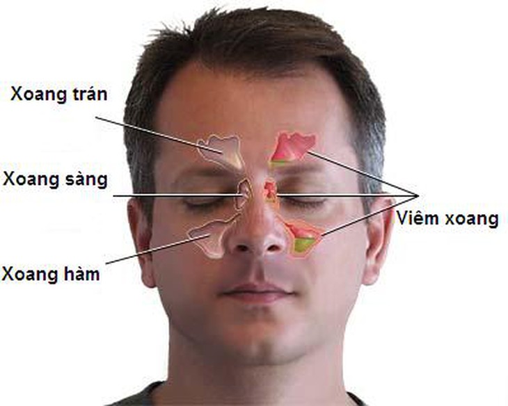  	Khi bị viêm xoang trán, bệnh nhân sẽ có những cơn đau đặc biệt: đau trên ổ mắt, một bên và có 2 chu kỳ mỗi ngày.
