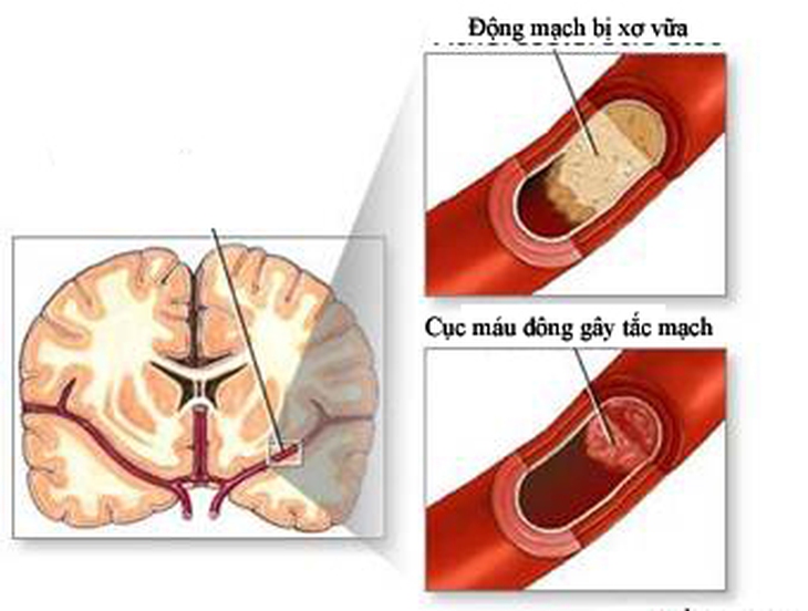  	Động mạch nuôi não bị xơ vữa hoặc tắc là nguyên nhân gây tai biến  mạch não.