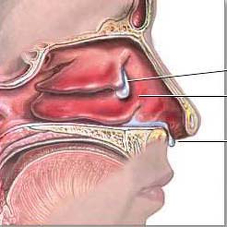 
	Cần tìm dị nguyên gây bệnh viêm mũi dị ứng để điều trị tận gốc.