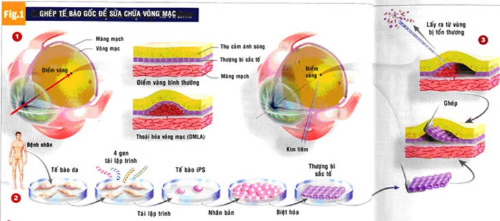  	(1): Điểm vàng, nằm ở trung tâm võng mạc, là vùng bị tổn thương do thoái hóa võng mạc theo tuổi.(2): Các tế bào da lấy từ bệnh nhân sẽ được tái lập trình thành tế bào iPS.(3): Lớp thượng bì sắc tố bị tổn thương và các mạch máu nằm dưới đó được phẫu thuật lấy ra. “Tấm thảm” tế bào mới được tạo ra sẽ được ghép vào lớp thượng bì sắc tố bị tổn thương.