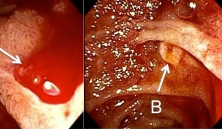 Sau cuộc nhậu, nôn ra cả chậu máu