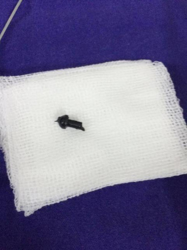 Các bác sĩ đã gắp ra dị vật là đầu đạn nhựa đen có chiều dài hơn 2cm. Ảnh BSCC