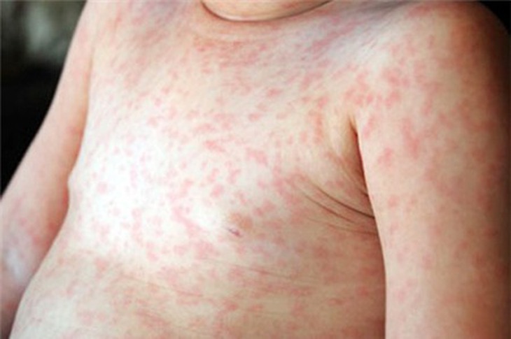 Nốt ban ở trẻ mắc sởi.