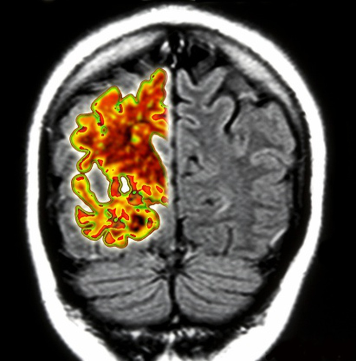 Hình ảnh não bị Alzheimer.