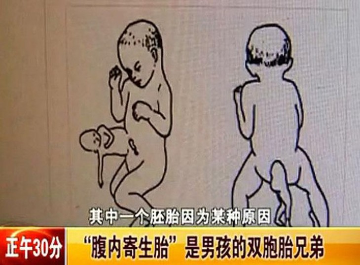 Nếu thai nhi phát triển bé Xiao có thể sẽ mất mạng. Ảnh: v.youku.com 