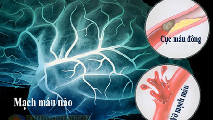 Hình ảnh đột quỵ não do tắc mạch máu.