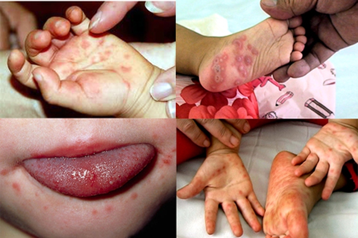 Tổn thương trong bệnh tay-chân-miệng.