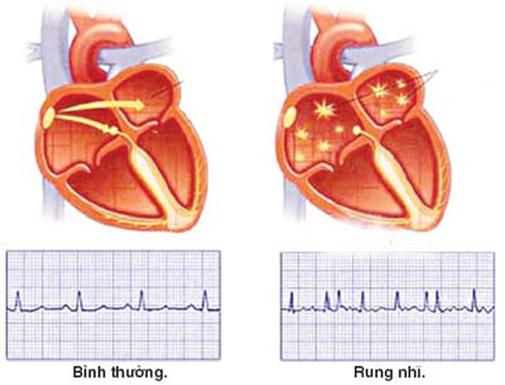Điện tâm đồ nhịp tim bình thường và nhịp tim trong bệnh rung nhĩ.