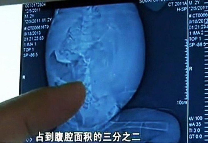 Thai nhi trong bụng Xiao đã hình thành xương sống và tay chân. Ảnh: v.youku.com