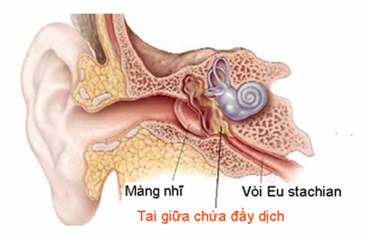 Viêm tai giữa thanh dịch