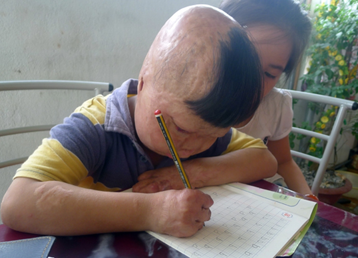 May mắn, bàn tay chỉ còn 4 ngón và tháo gần hết đốt vẫn có thể cầm bút.