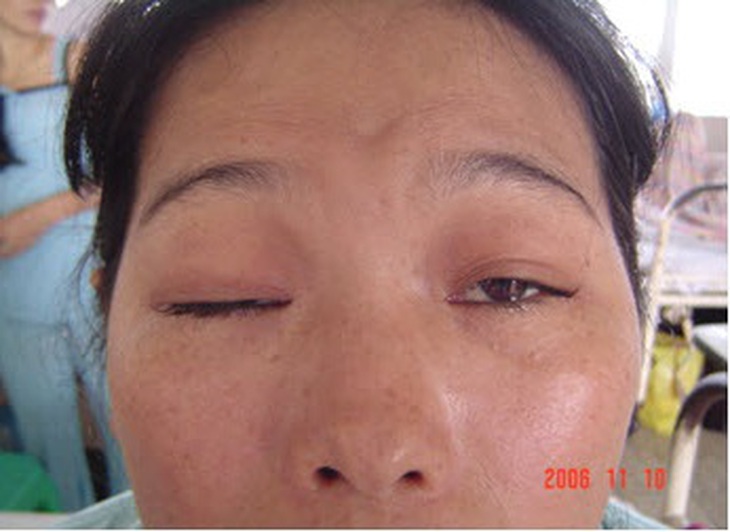 Dấu hiệu sụp mi trong bệnh nhược cơ.