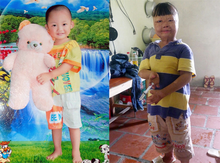 Bé Linh trước và sau khi bị cha tưới xăng lên người và đốt