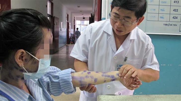 Tổn thương thủy đậu ở người lớn.