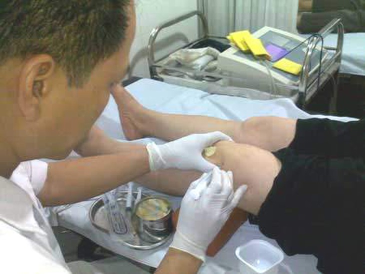 Điều trị cho bệnh nhân&nbsp;viêm khớp mủ.