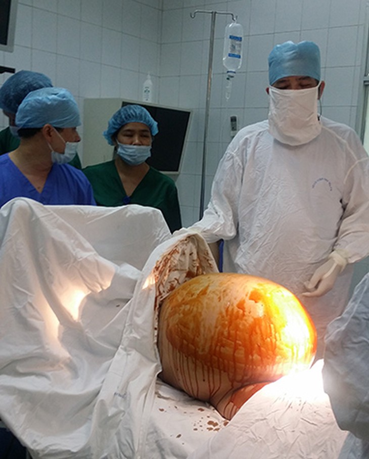 Tổng trọng lượng (tính thêm cả dịch nhầy của khối u) mà bệnh nhân Đ.T.M mang suốt 9 tháng 10 ngày là hơn 23kg!