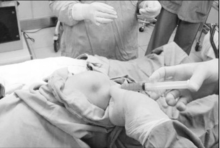 Sử dụng tế bào gốc mô mỡ tự thân trong điều trị thoái hóa khớp gối.
