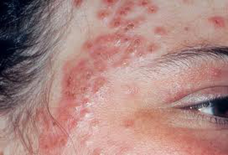 Bệnh chàm. Nguồn ảnh: WebMD