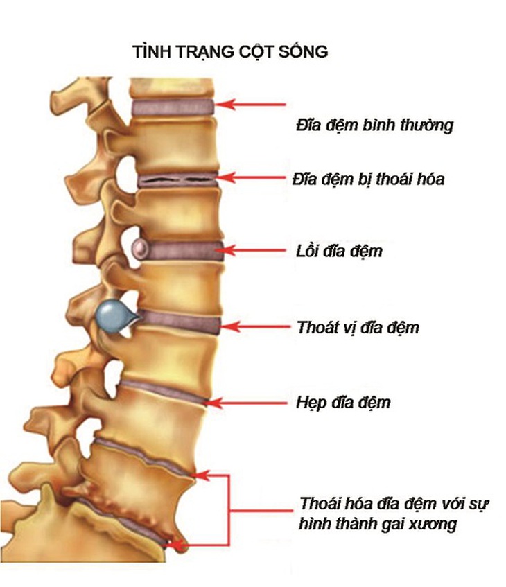 Gai cột sống nếu để lâu ngày không được chữa trị có thể gây nên biến chứng