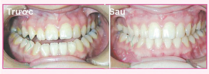 Bệnh nhân trước và sau khi phẫu thuật chỉnh hàm hô móm