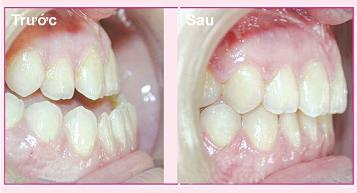Bệnh nhân trước và sau khi phẫu thuật chỉnh hàm hô móm