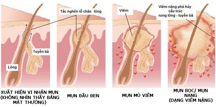 Tắc nghẽn lỗ chân lông gây mụn.