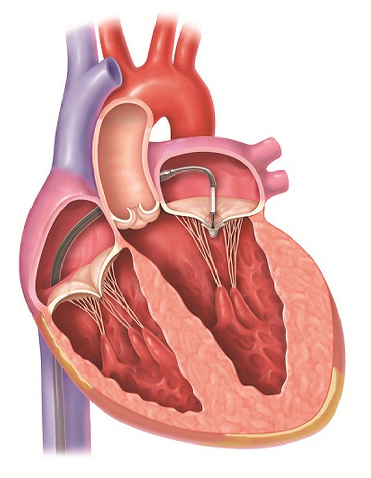 MitraClip giúp giảm thiểu hiện tượng máu bị trào ngược, giảm thiểu các triệu chứng và thời gian nằm viện