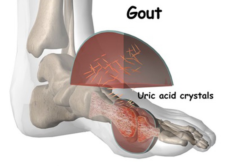 Hình ảnh tổn thương khớp do gút.