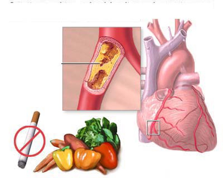 Hút thuốc lá gây nguy cơ cao mắc bệnh động mạch vành.