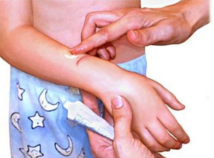 Sử dụng kem bôi trị nhiễm khuẩn.