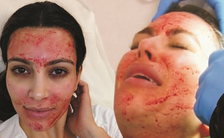 Kim Kardashian đang làm PRP bằng bút châm