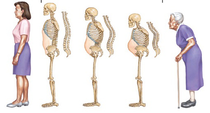 Loãng xương có thể khiến chiều cao người bệnh bị lùn đi 3 -5 cm khi về già