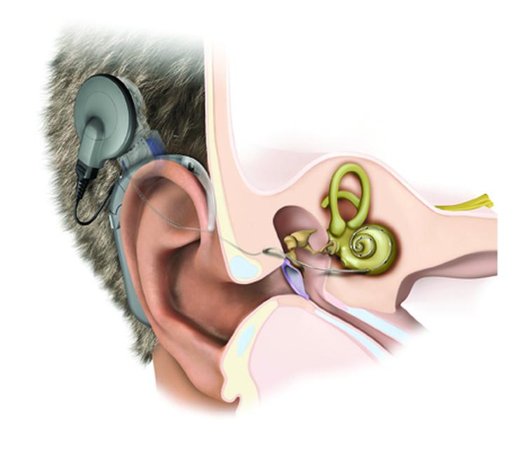 Cấy ốc tai cho người suy giảm thính lực