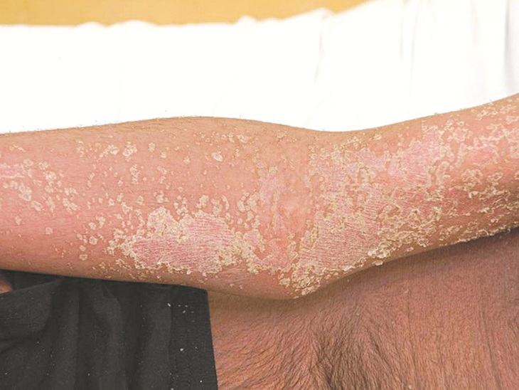 Da của người bị bệnh Sclerodermie