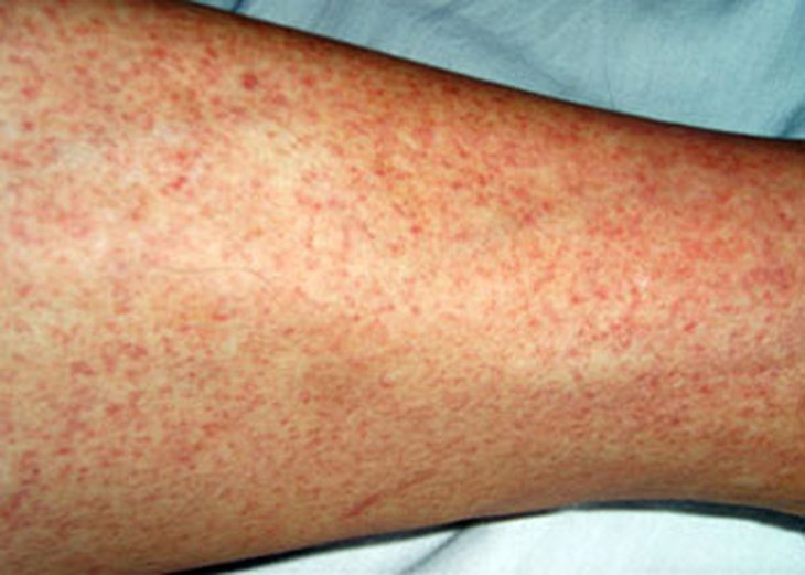 Hình ảnh sốt xuất huyết dengue
