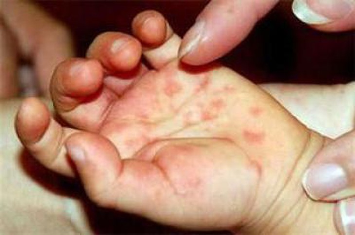 Sang thương bóng nước ở bệnh tay chân miệng