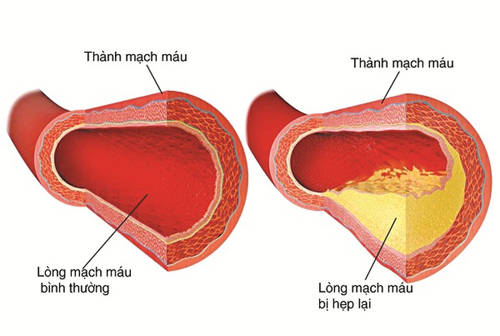 Lượng máu đi lên não kém có thể do hiện tượng xơ vữa động mạch làm cho lòng mạch máu hẹp lại