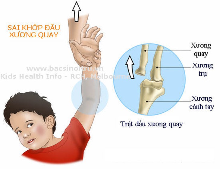 Trật khớp khuỷu tay xảy ra khi bé bị kéo tay đột xuất, hay bị té.
