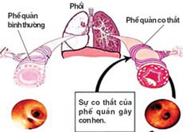Bệnh hen là bệnh lý hô hấp rất phổ biến.